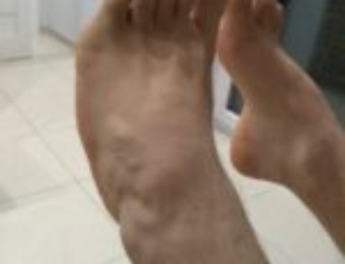 Stopa końsko-szpotawa