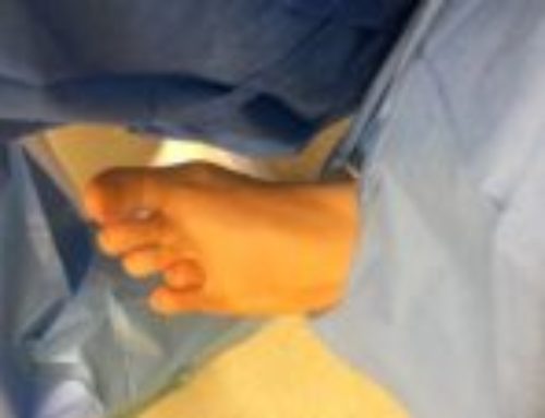 Wada wrodzona hypoplazja IV promienia stopy